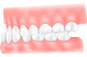 受け口(下顎前突:かがくぜんとつ)