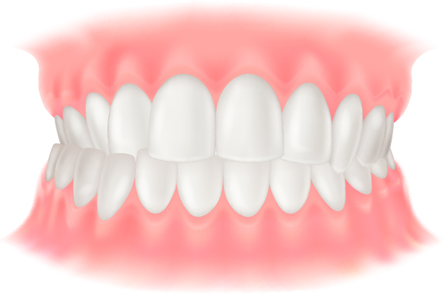 交叉咬合(こうさこうごう)