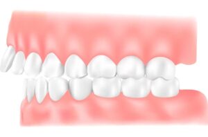 出っ歯(上顎前突:じょうがくぜんとつ)