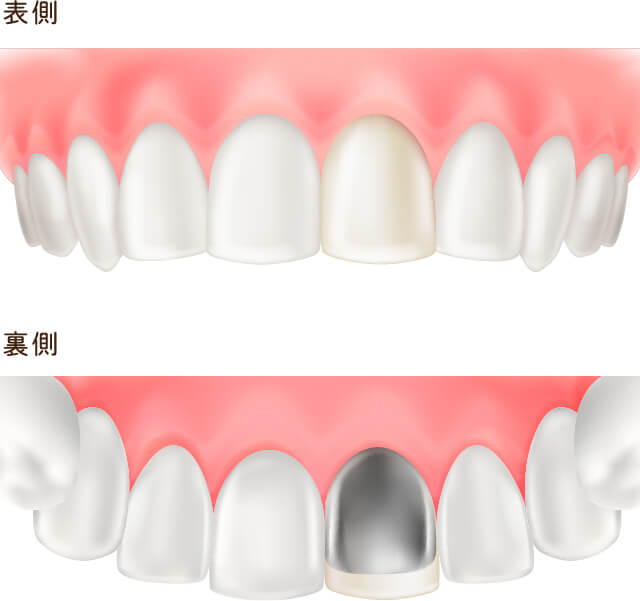 硬質レジン前装冠(前歯のみ)