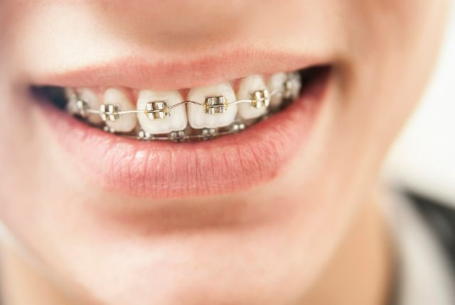 矯正装置をつけて笑う男性