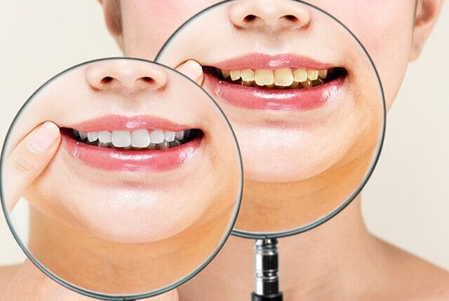 審美歯科を受けた女性のBefor・After