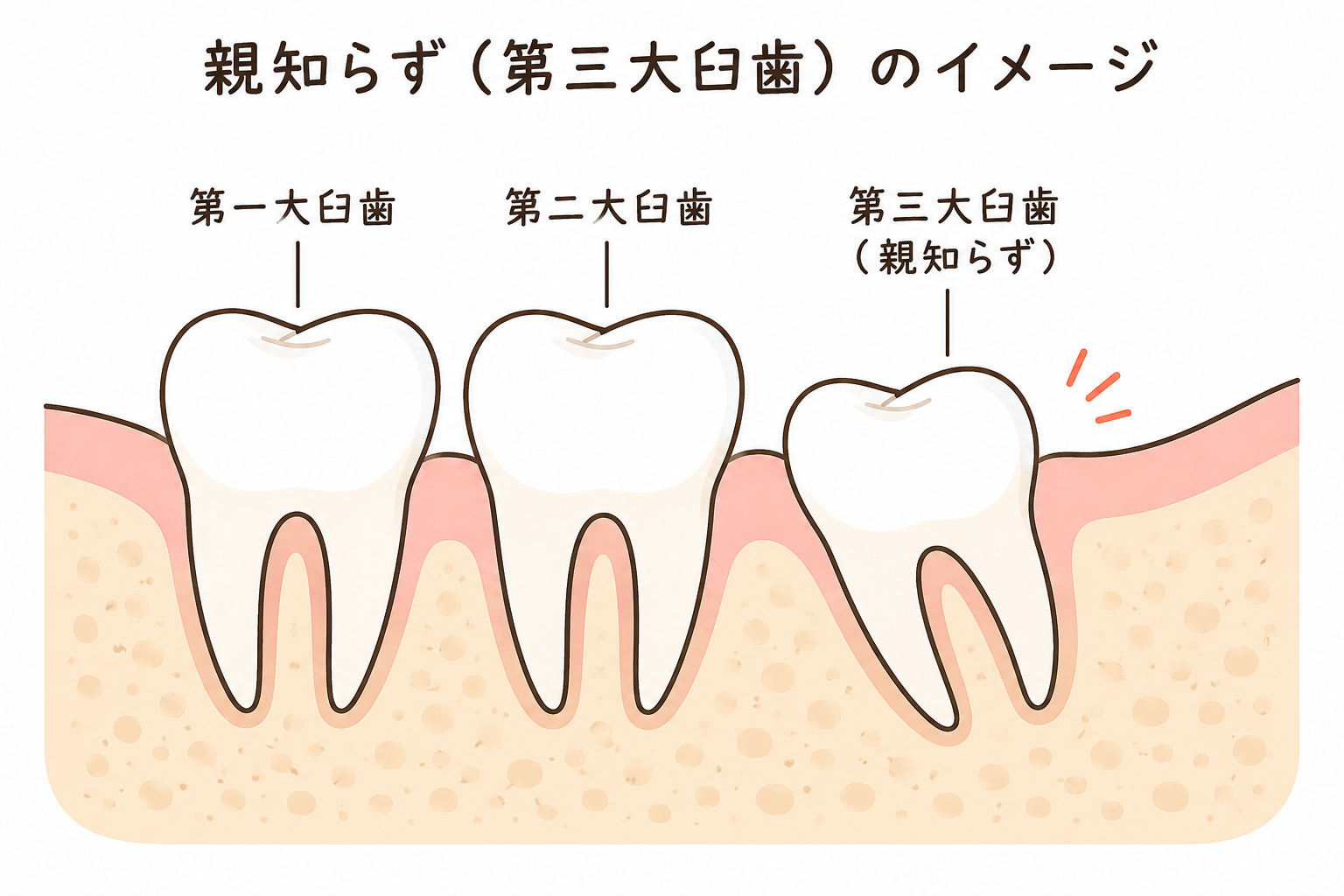 親知らずは抜くべき？