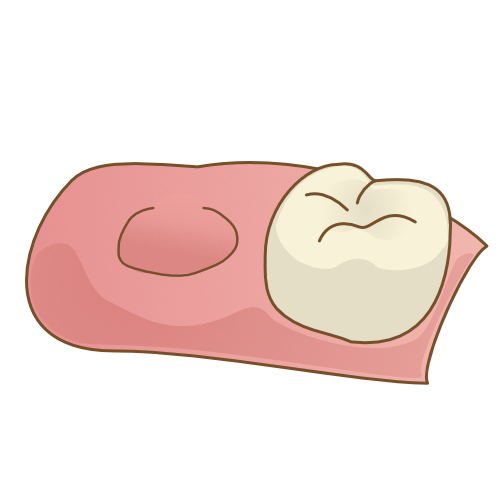歯を抜いたままにすると・・・